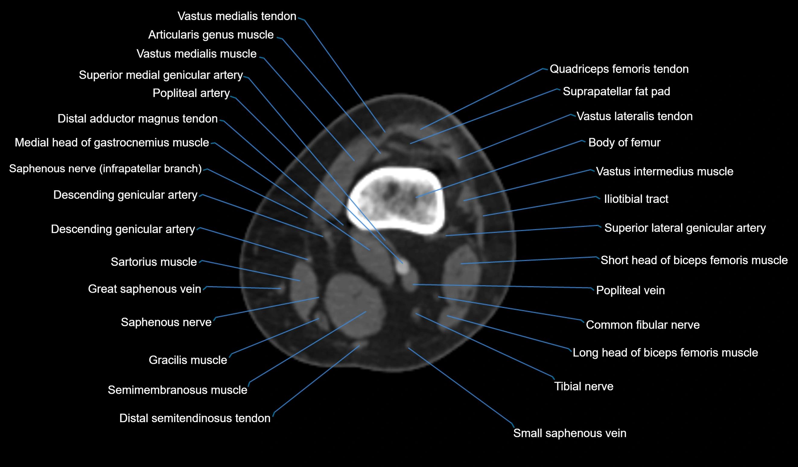 CT knee axial cross sectional anatomy labelled image-00017.webp